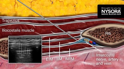 intercostal nerve block.